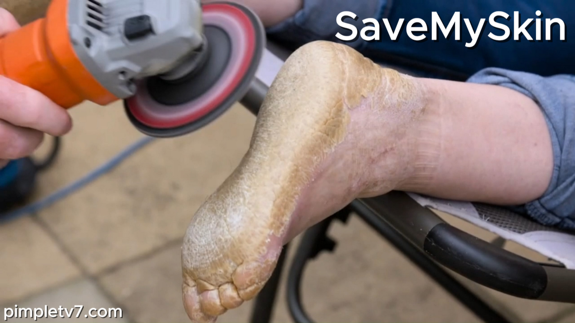 The skin on Yvonne’s hands and feet is so thick, her husband uses dangerous measures to remove it. SaveMySkin 050926