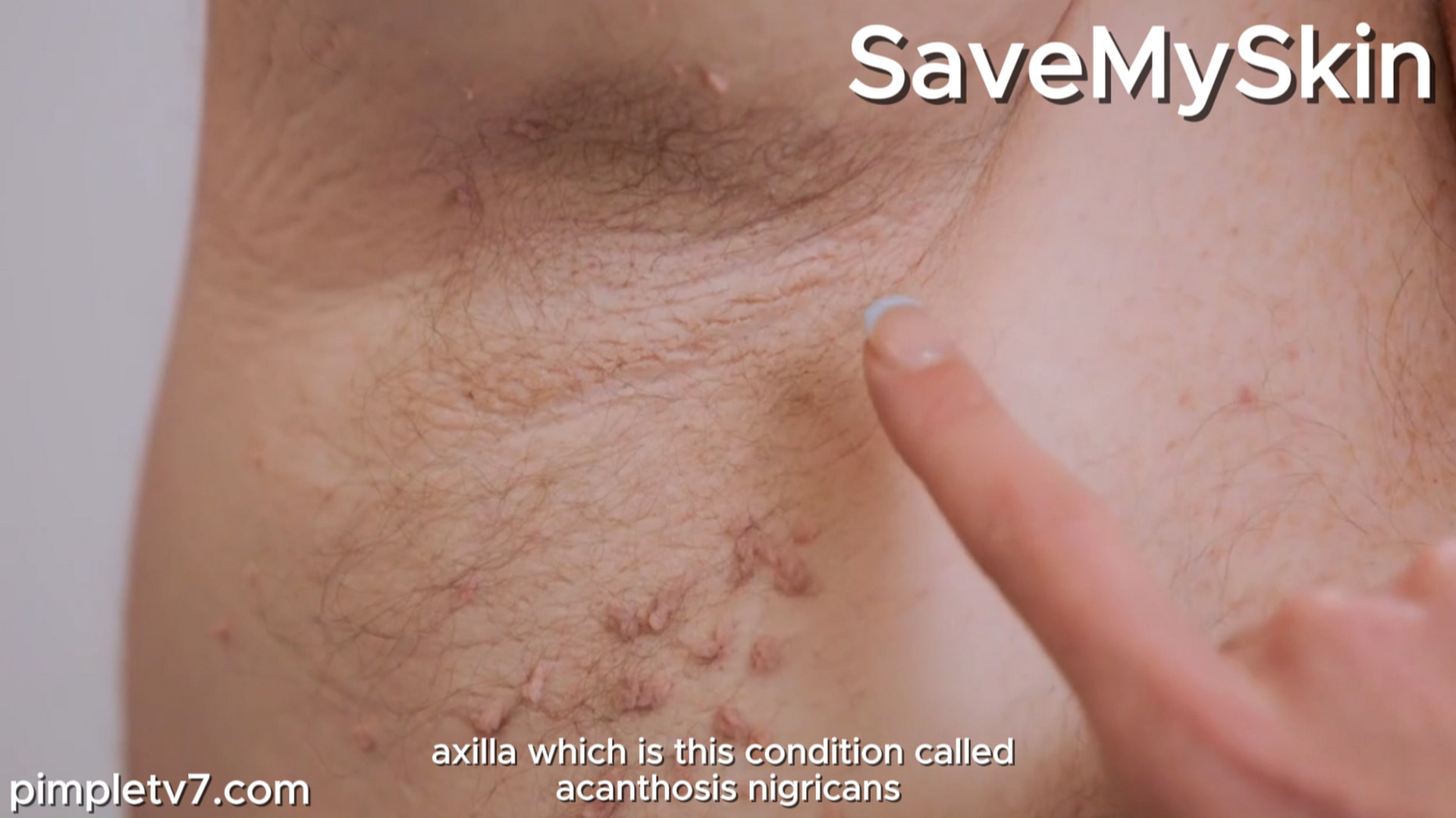 Dr. Emma has an unusual treatment plan to try to treat his debilitating symptoms. SaveMySkin 180926