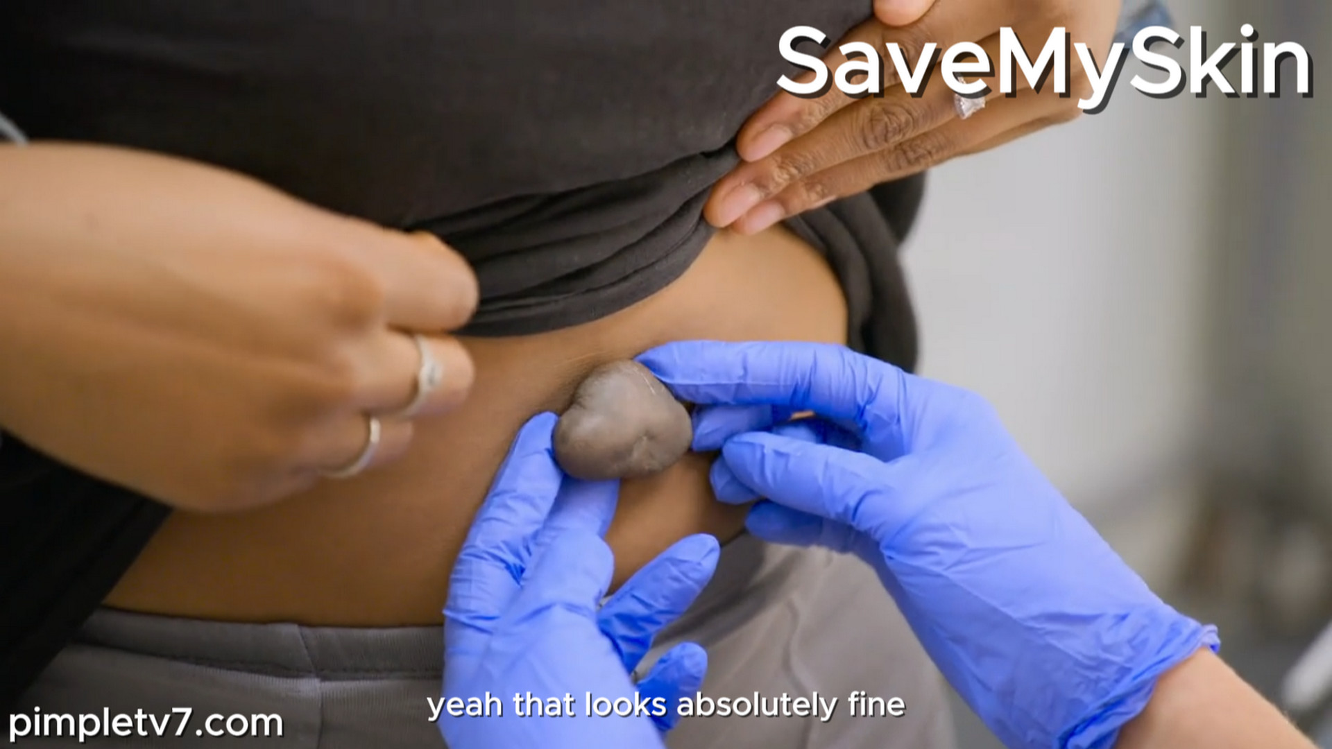 Toni had a keloid on her belly piercing about one year ago. SaveMySkin 240926