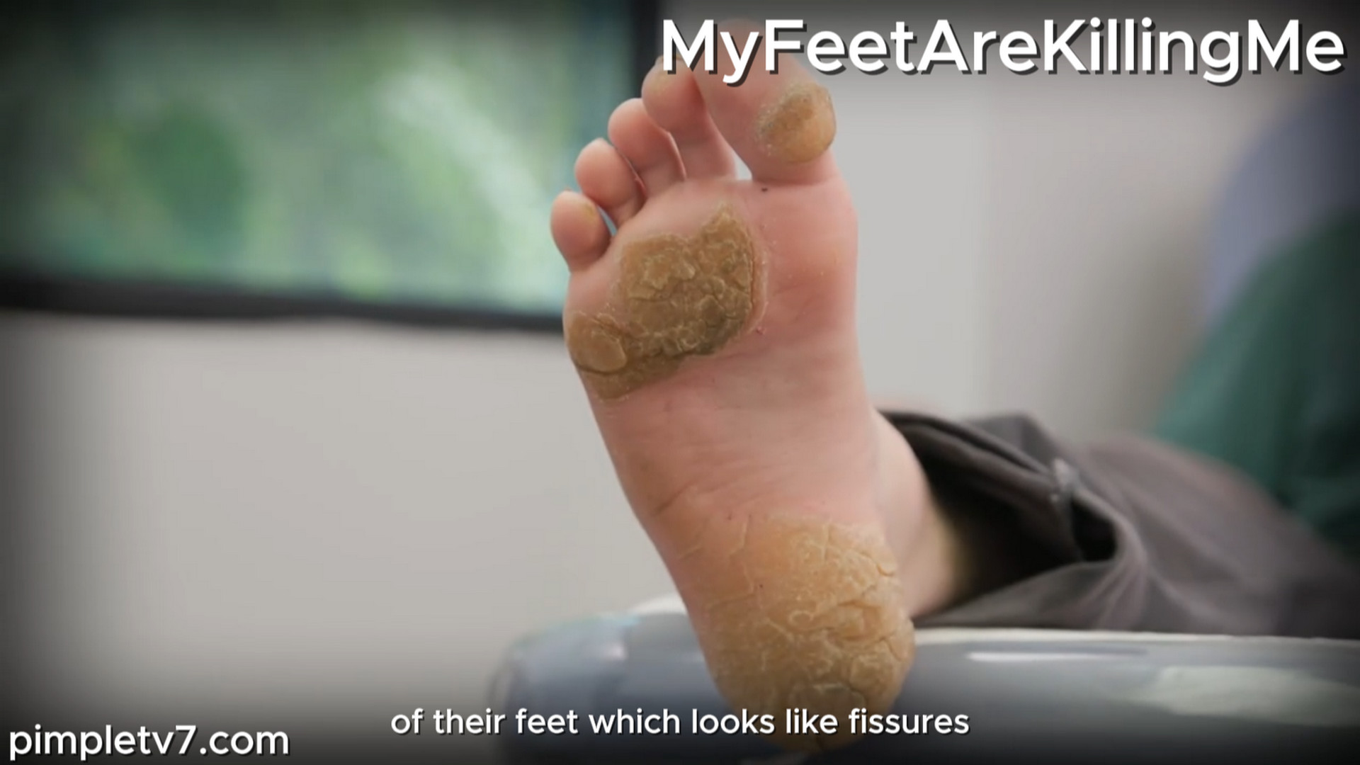 When a man that urinates on his feet. MyFeetAreKillingMe 300926