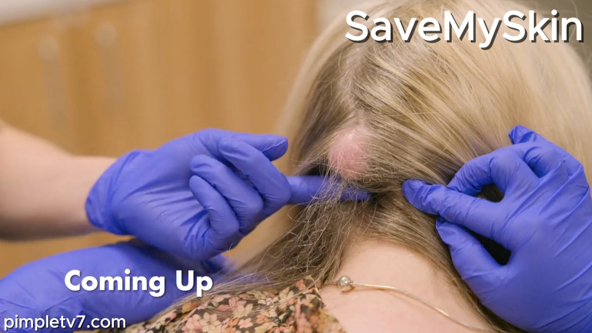 Cysts have been growing on Carol’s head for over four decades. SaveMySkin 020926