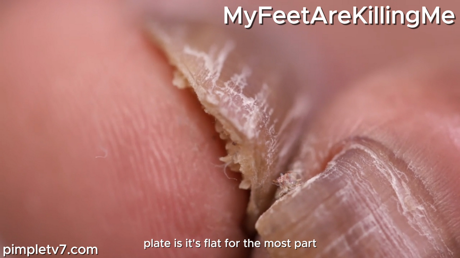 A dancer with towering toenails who brings his pampered pooch to his appointment. MyFeetAreKillingMe 231026
