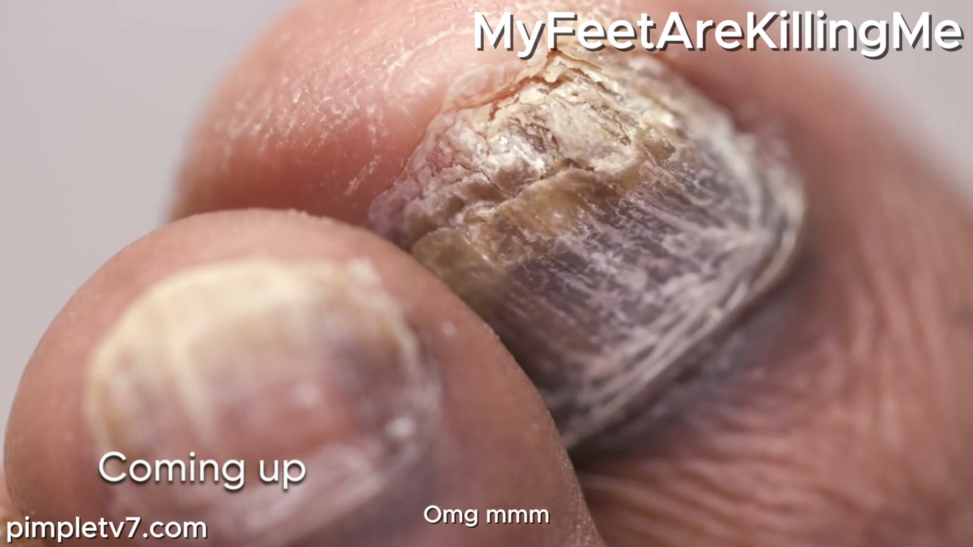 A devoted husband hopes Dr. Sarah can rid his feet of fungus and save his marriage. MyFeetAreKillingMe 311026