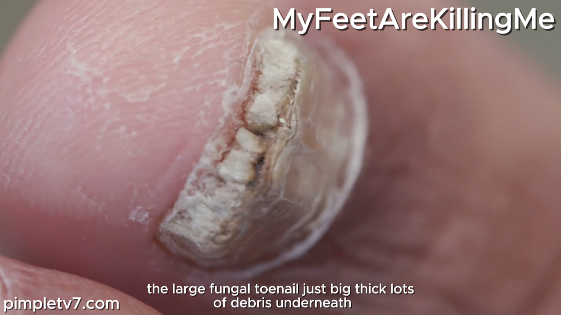 A man who has never scrubbed his feet shocks Dr. Ebonie. MyFeetAreKillingMe 131026