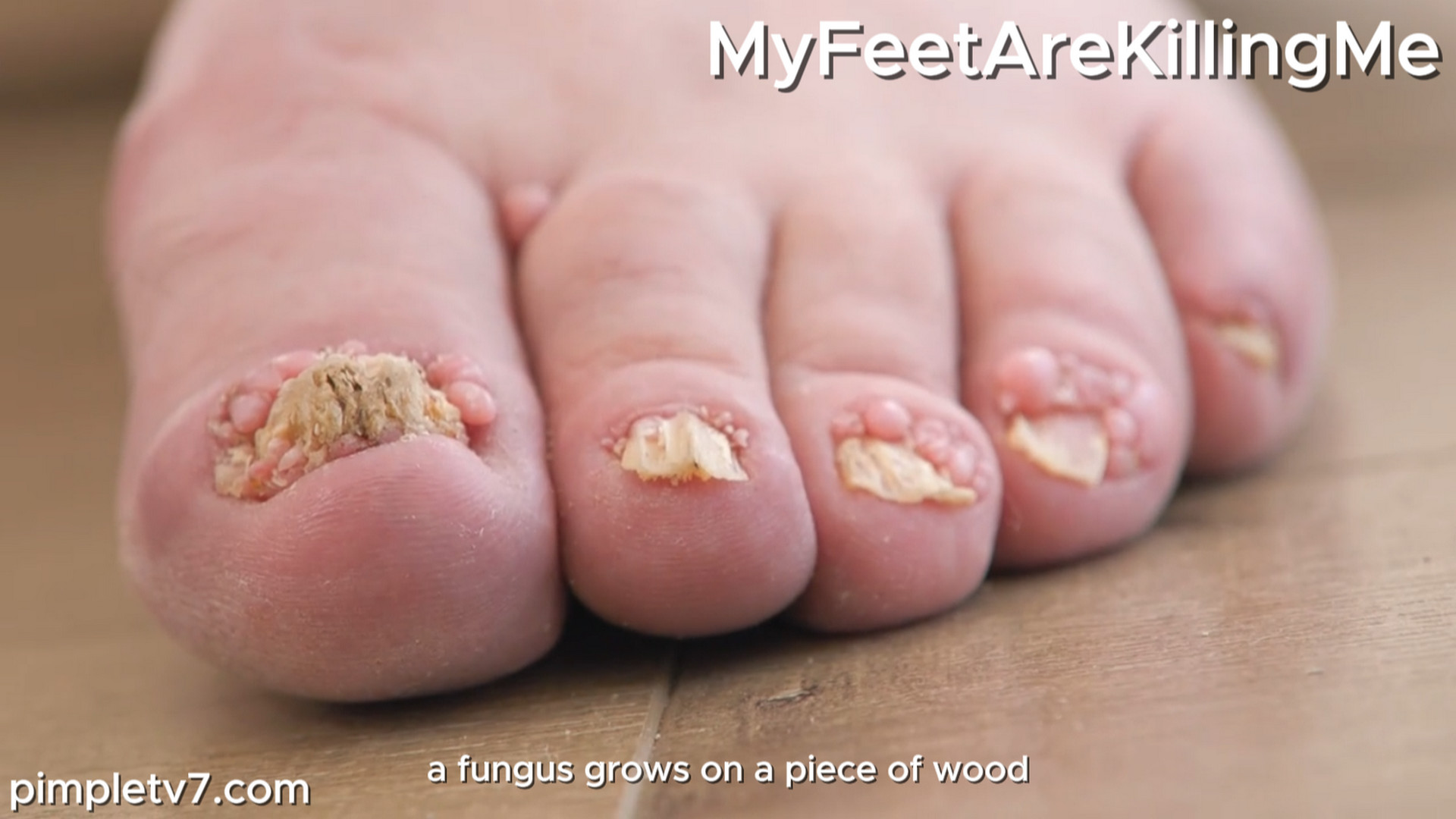 A man with tiny tumors all over his toes. MyFeetAreKillingMe 021026