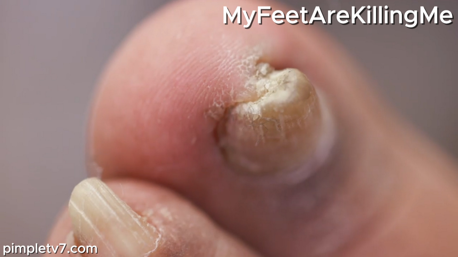 A patient whose toenails cut holes in her shoes. MyFeetAreKillingMe 021026
