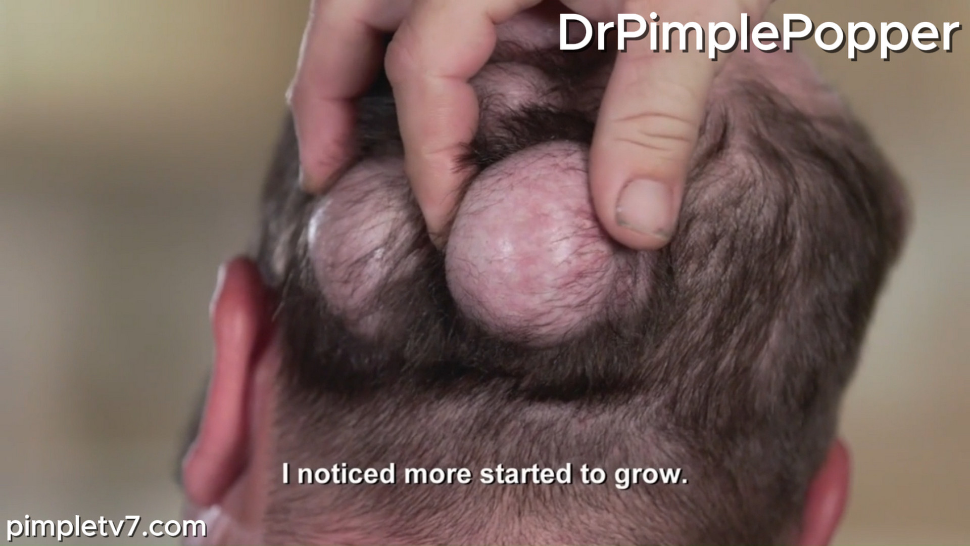 After losing his longtime love, Joe wants the large bumps all over his head removed. Dr. Pimple Popper 241026