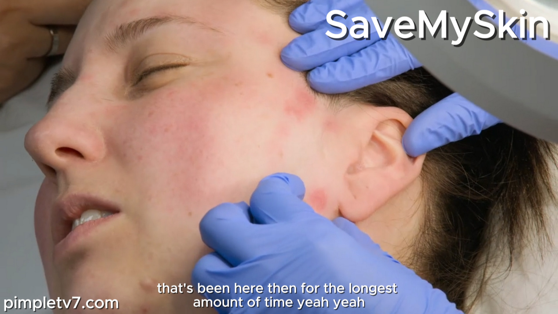 Amy can’t go out without a mask of makeup to hide the angry red blotches on her face. SaveMySkin 041026