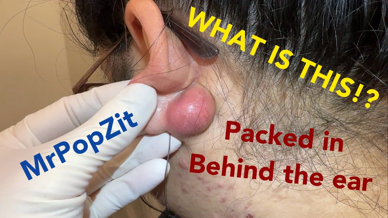 BATTLE OF THE BULGE! Come on the struggle bus and watch me remove this tricky growth! See how it heals. Mr. PopZit 281026
