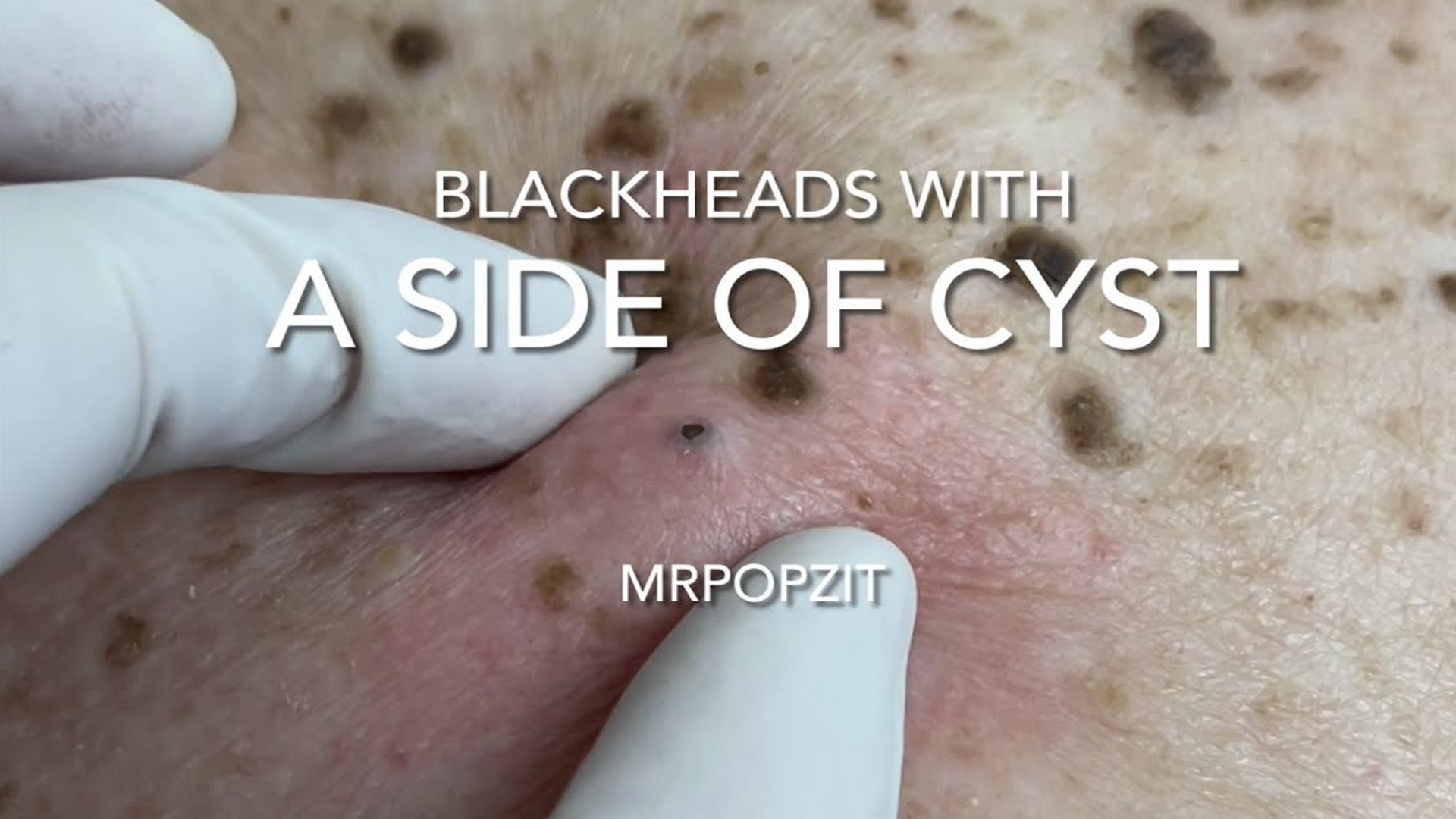 Blackheads with a side of cyst. Blackhead extractions and cyst excision with closure. Cyst dissection. Mr. PopZit 091026
