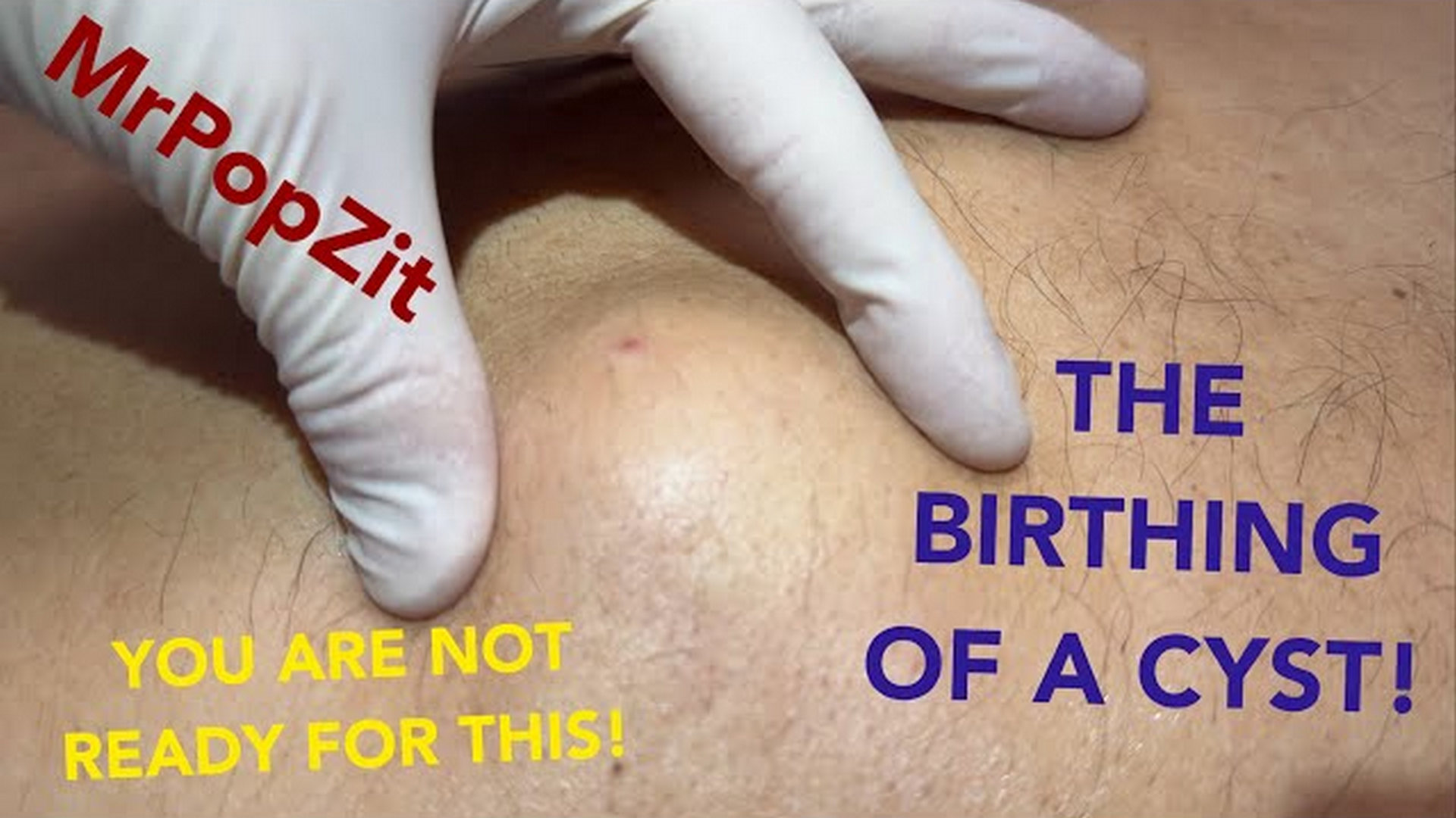 Bottomless pocket of Purulence! It just keeps flowing! You won’t believe how much is in there!! Mr. PopZit 241026