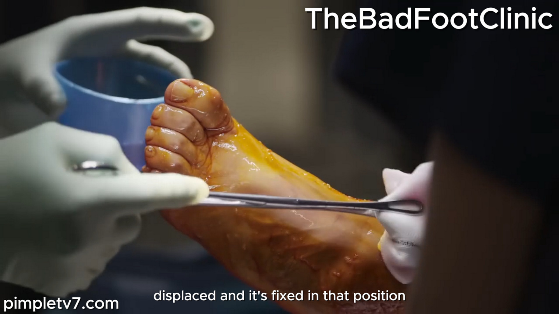 But strange smells, stubborn verrucae, and hooked toes are all in a day’s work for Podiatrist Marion. TheBadFootClinic 211026