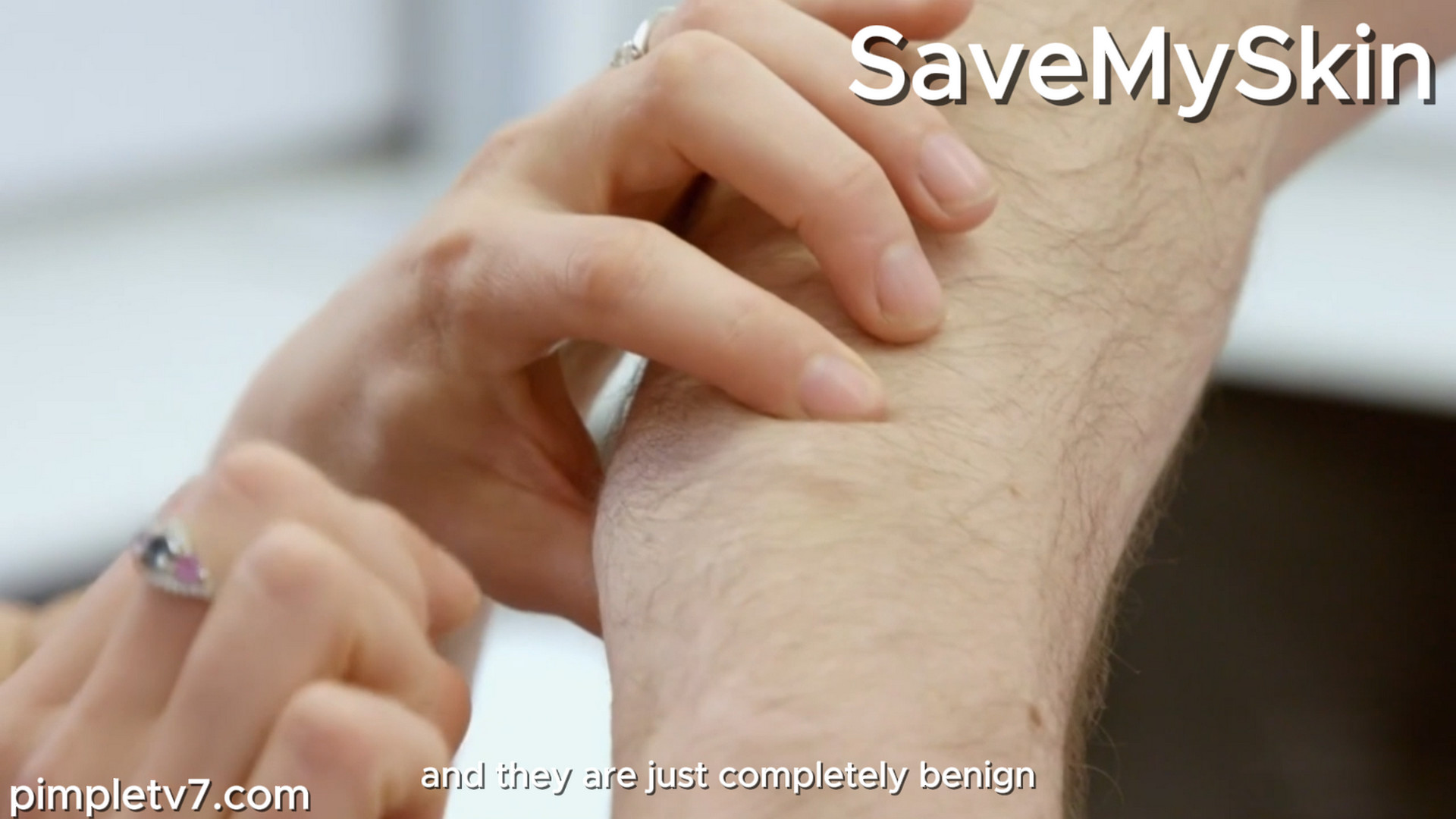 Callum’s lumps give Dr. Emma cause for concern. SaveMySkin 211026