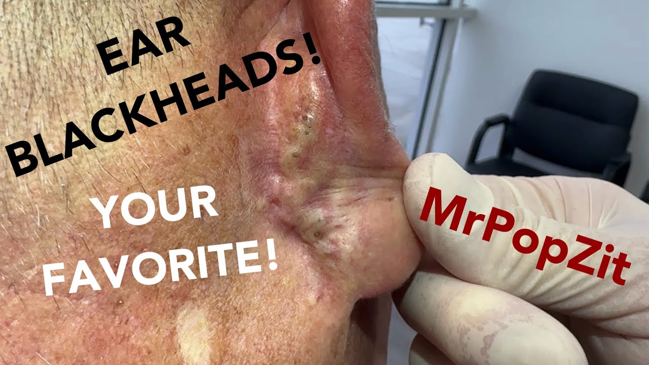 Deep embedded ear blackheads! Watch me clear the pores and remove follicular cysts. Your favorite! Mr. PopZit 291026