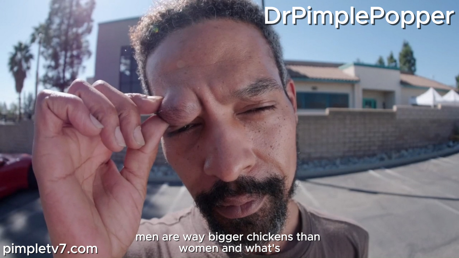 Djuka is a stubborn guy with a stubborn bump. Dr. Pimple Popper 291026