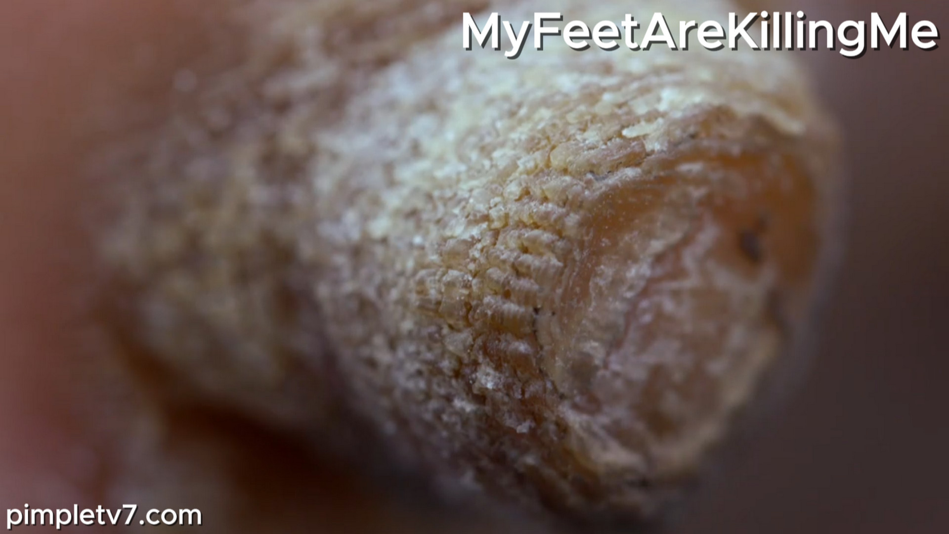 Dr. Brad removes growths like horns coming out of a woman’s feet. MyFeetAreKillingMe 151026