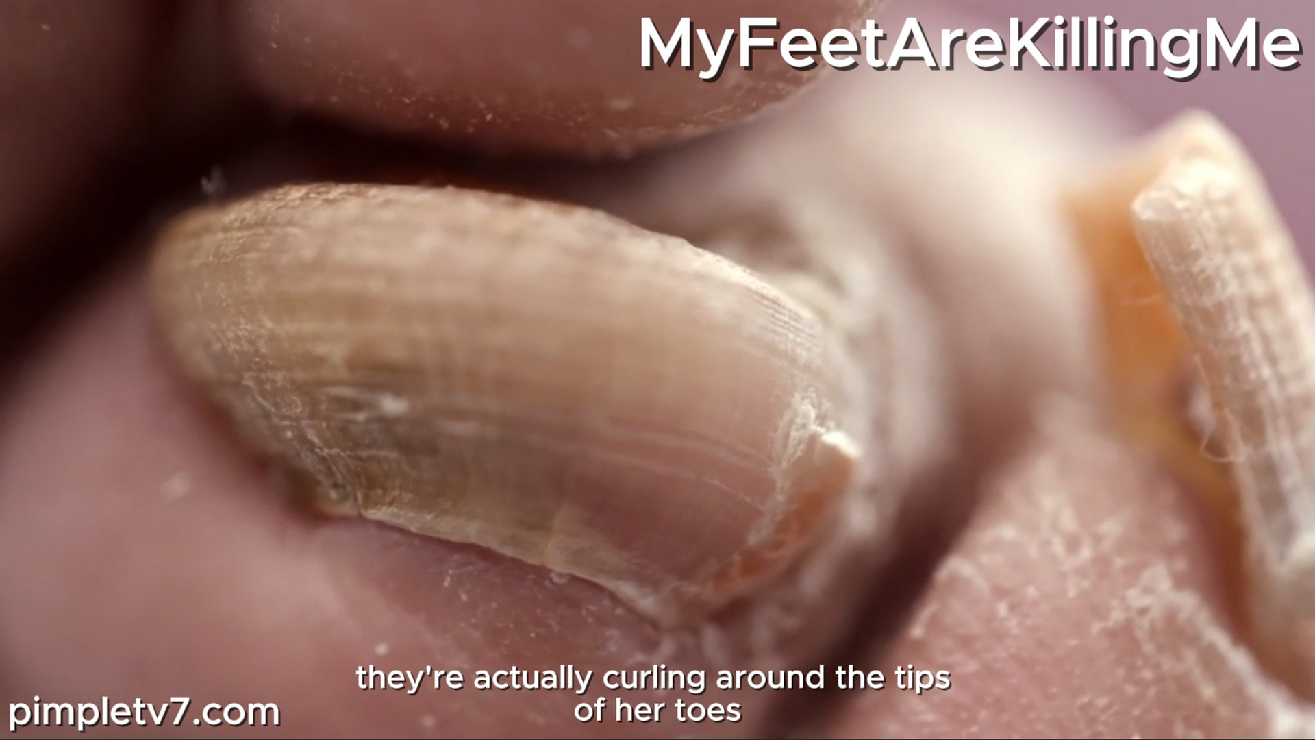 Dr. Brad takes a scalpel to a massive heel growth, but the patient refuses to take numbing shots. MyFeetAreKillingMe 271026