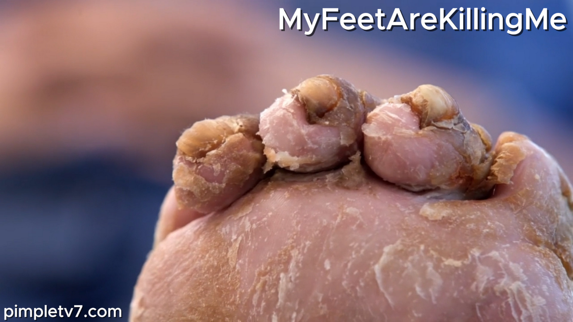 Dr. Ebonie helps a woman who hasn’t seen her foot in almost two years. MyFeetAreKillingMe 171026