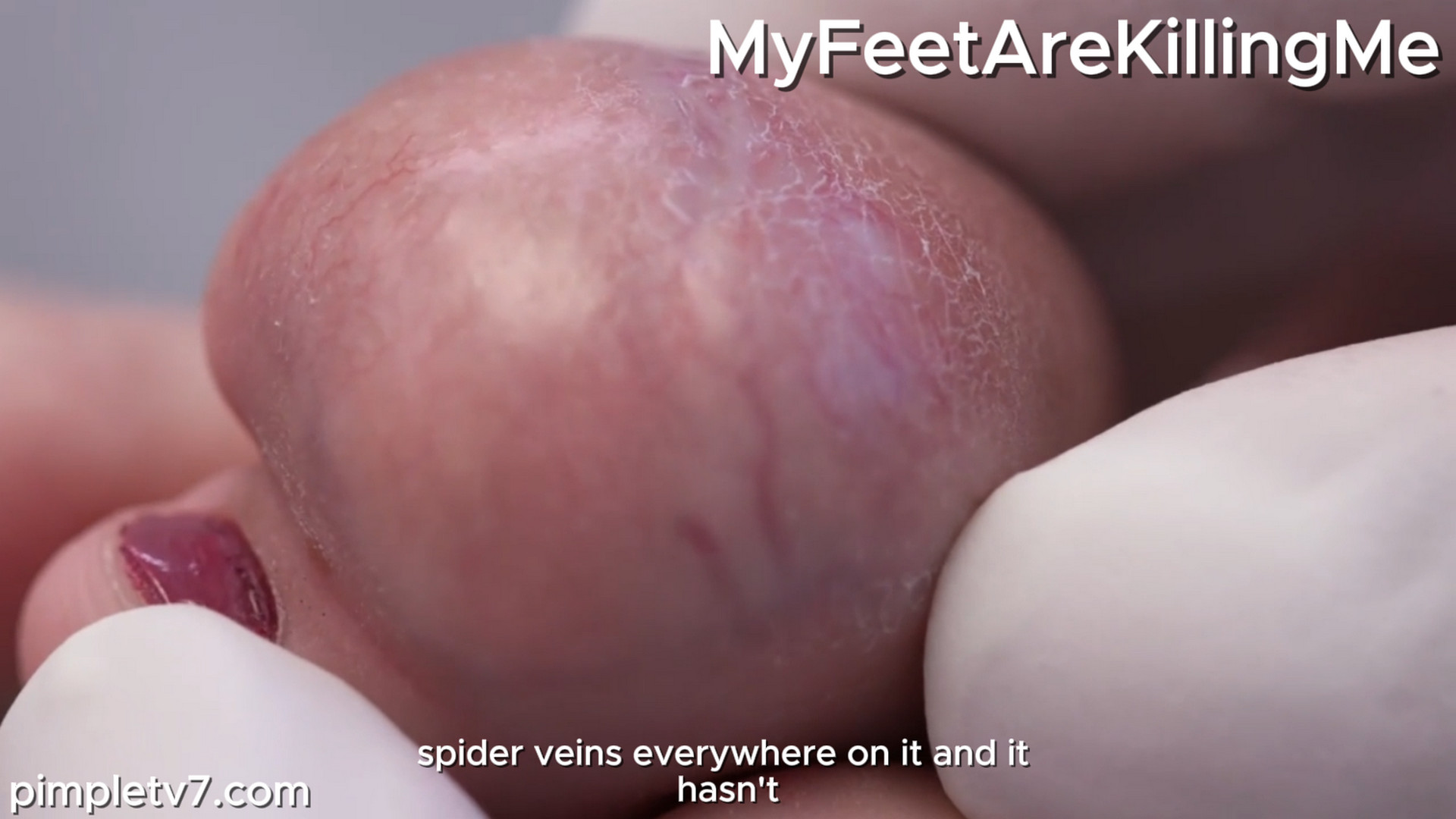 Dr. Ebonie removes an alien brain growing out of a cancer-survivor’s toe. MyFeetAreKillingMe 241026
