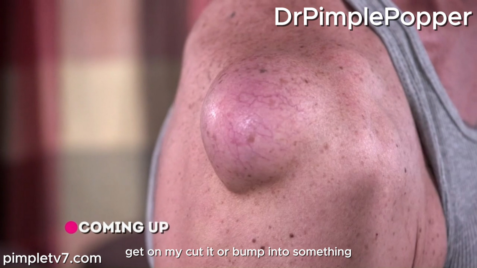 Dr. Sandra Lee, Will fears his shoulder lump will be ripped open at work. Dr. Pimple Popper 051026