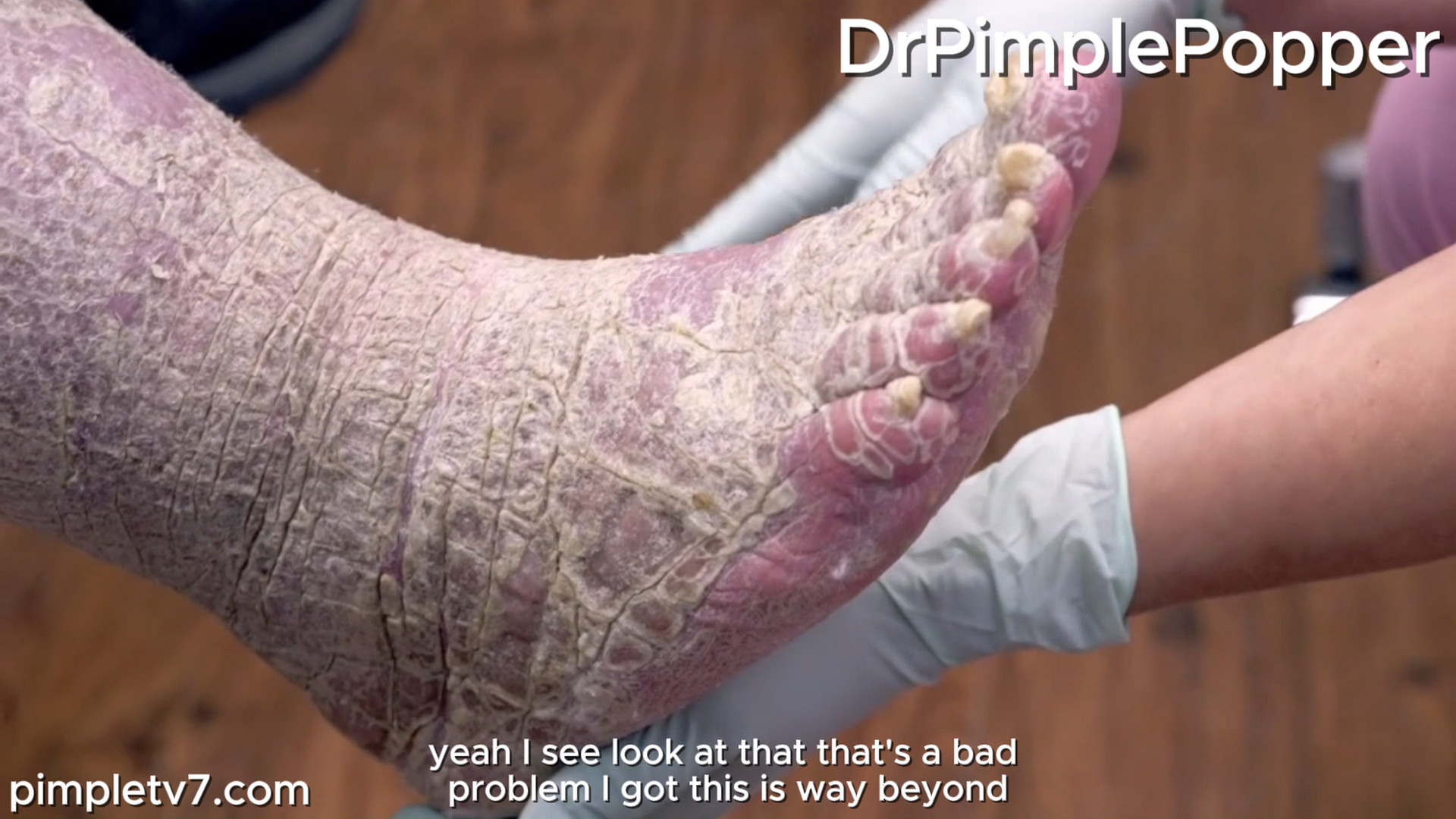 Dr. Sandra Lee assists Louis, who is covered in scaly, dry skin that makes him feel like an alligator. Dr. Pimple Popper 161026