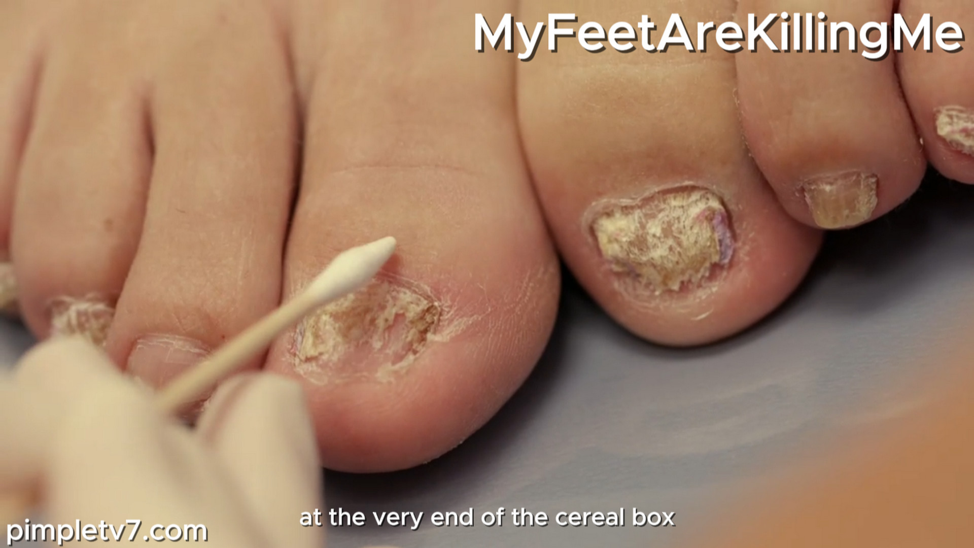 Dr. Sarah treats three sisters and their six fungus feet. MyFeetAreKillingMe 161026