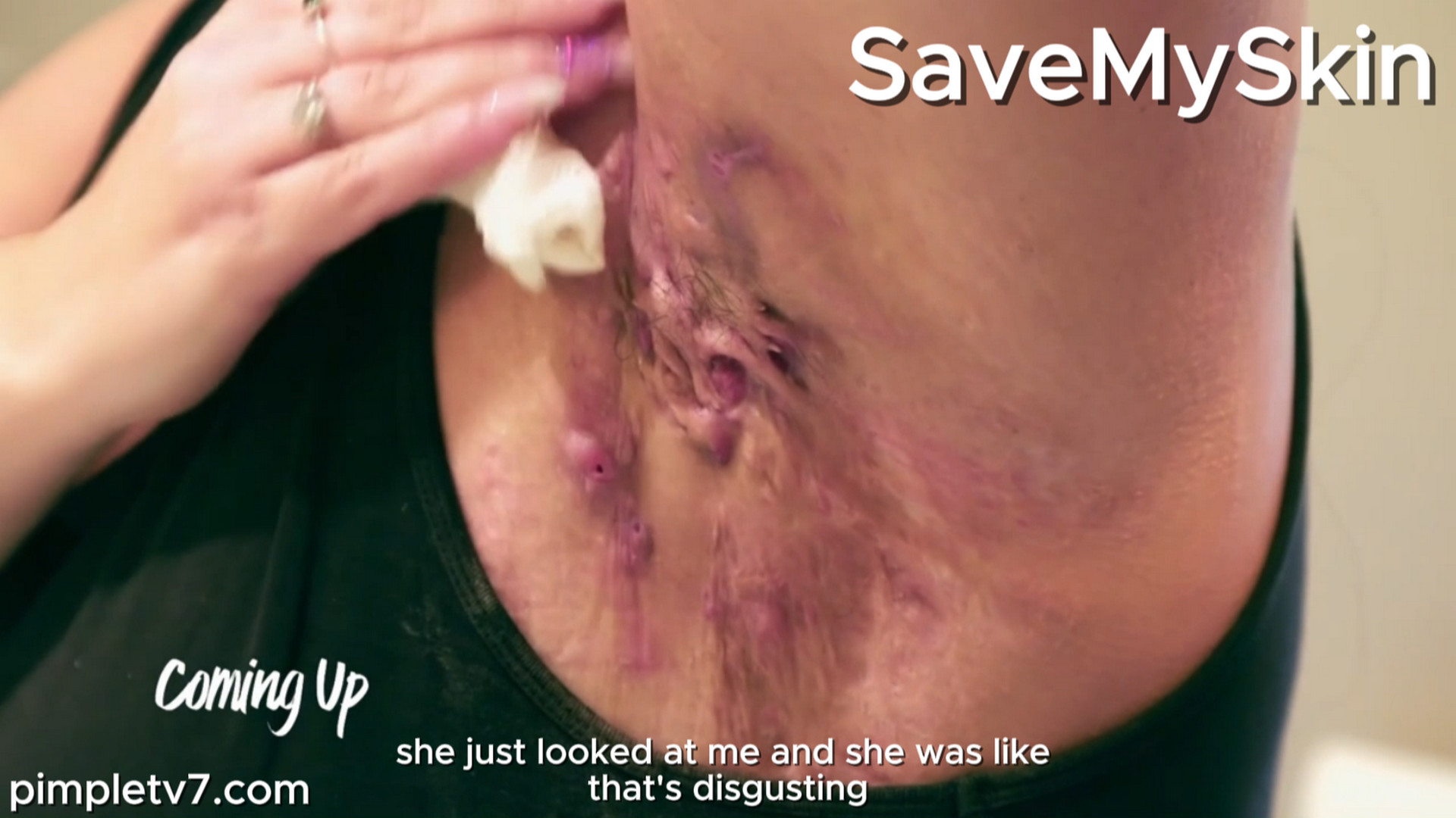 Elise is tormented by leaking abscesses and lesions that then burst. SaveMySkin 081026