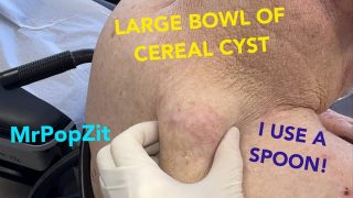 GIANT CYST removed with a spoon! Tricky removal with heart condition and wheelchair, but I get it done. Mr. PopZit 181026