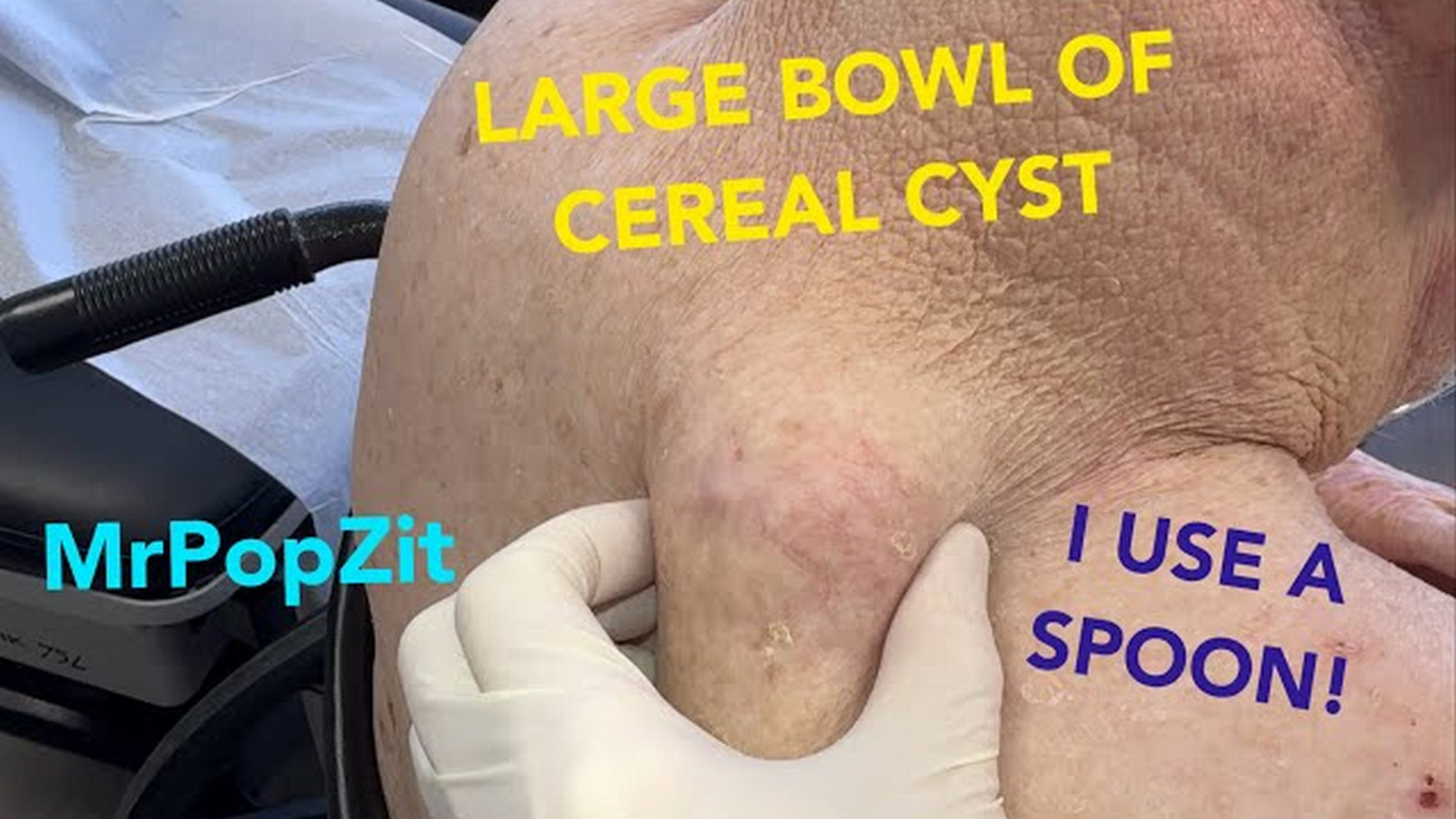 GIANT CYST removed with a spoon! Tricky removal with heart condition and wheelchair, but I get it done. Mr. PopZit 261026