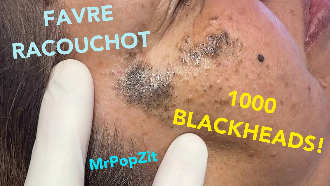 Get ready for 1,000 blackheads extracted! Favre Racouchot. Excavating deep pore dirt! Mr. PopZit 281026