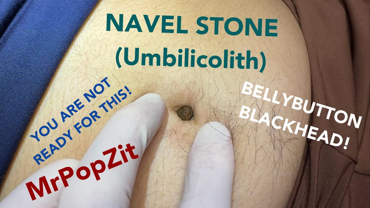 UMBILICOLITH! Giant bellybutton blackhead! Extremely rare to see! You won’t believe how deep it goes! Mr. PopZit 271026