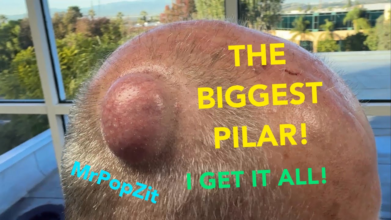 Gigantic Pilar Cyst! Don’t miss this one; it has it all! Unique secondary encapsulated lining. Mr. PopZit 161026