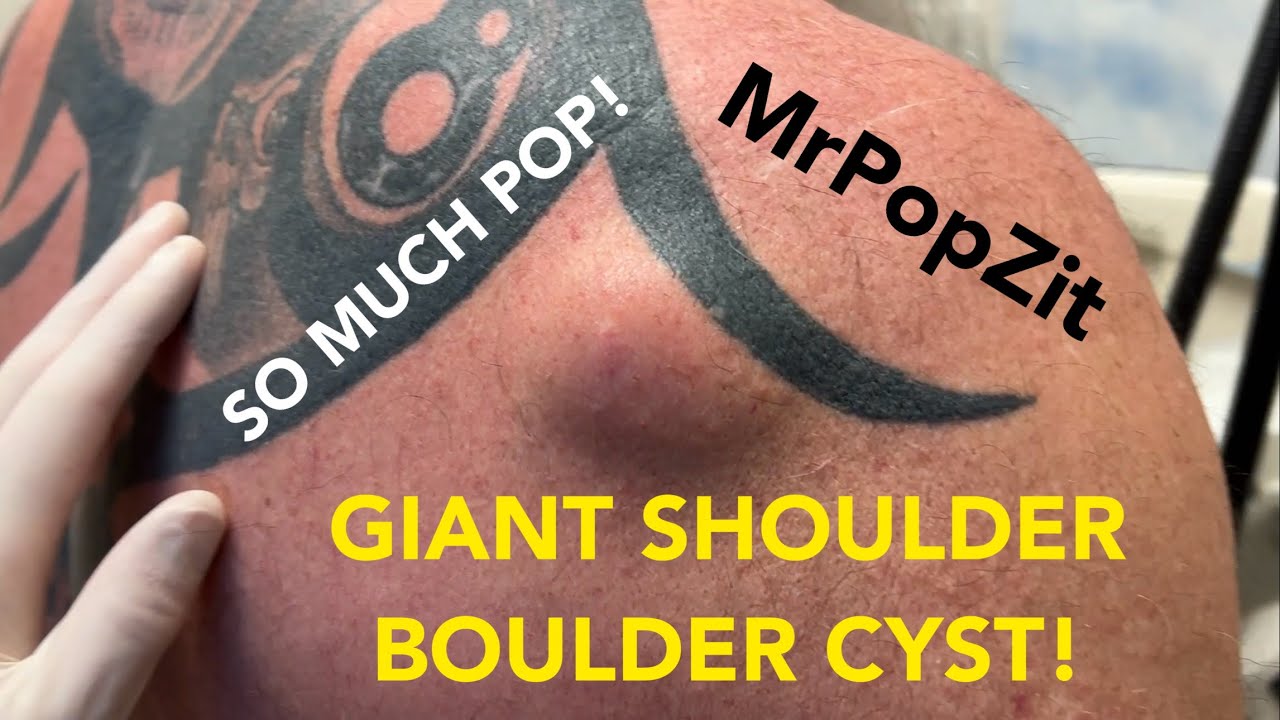 Gigantic mass on posterior shoulder popped,full sac removed, and closure of open pocket. See it all! Mr. PopZit 271026