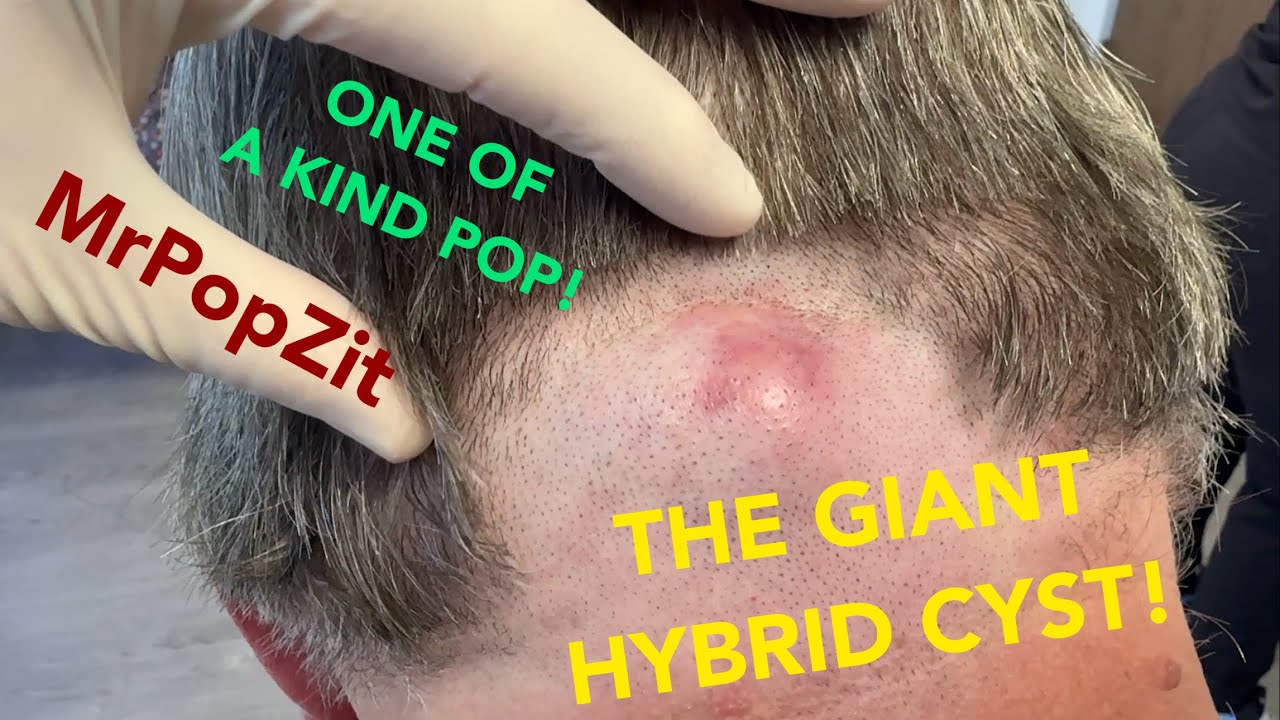 HYBRID CYST! First one on my channel! Very large, deep growth removed on the posterior neck. Mr. PopZit 281026