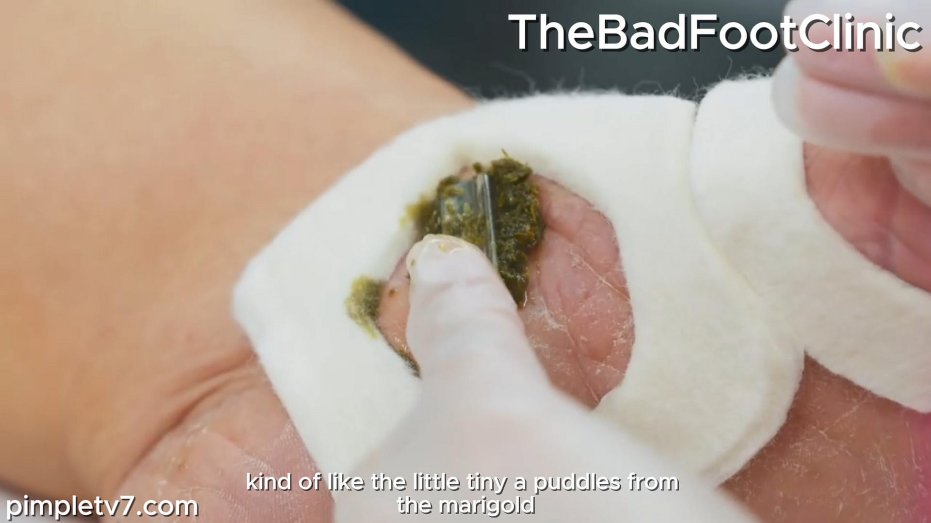 Has a surprising treatment for a psoriasis patient who’s tried everything. TheBadFootClinic 171026