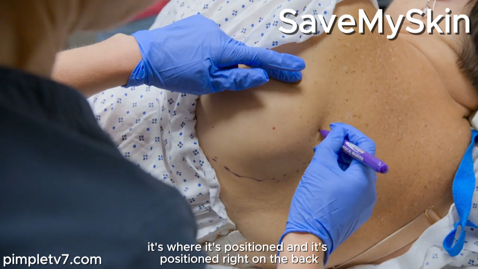 Heather’s lump has grown to the size of an avocado after she fell from a ladder onto a wheelie bin. SaveMySkin 021026