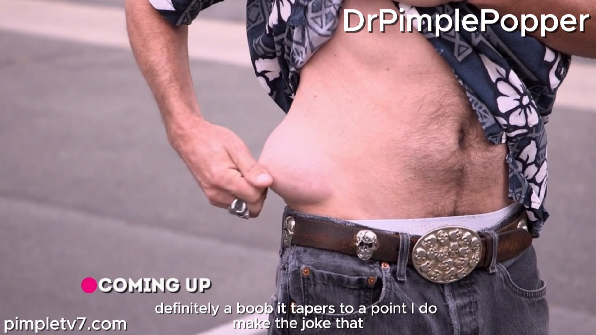 John jokes about a lump on his hip that’s no laughing matter. Dr. Pimple Popper 081026