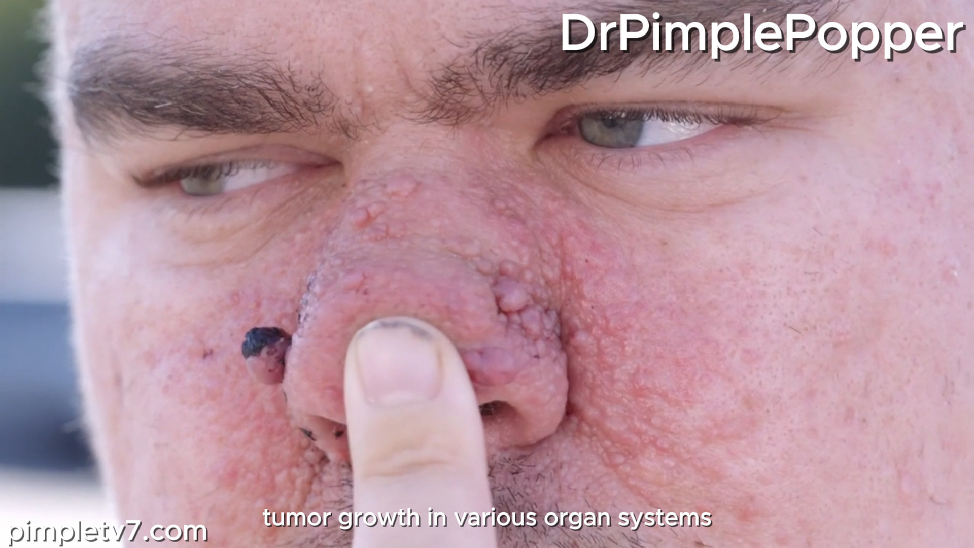 Jordan has autism and was born with a condition that causes small bumps to grow on his nose. Dr. Pimple Popper 201026