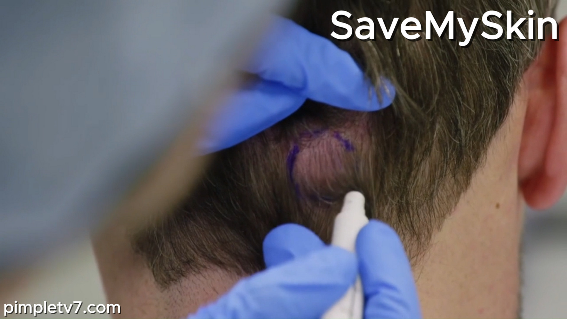 Jordan’s scalp is strewn with pilar cysts. SaveMySkin 221026