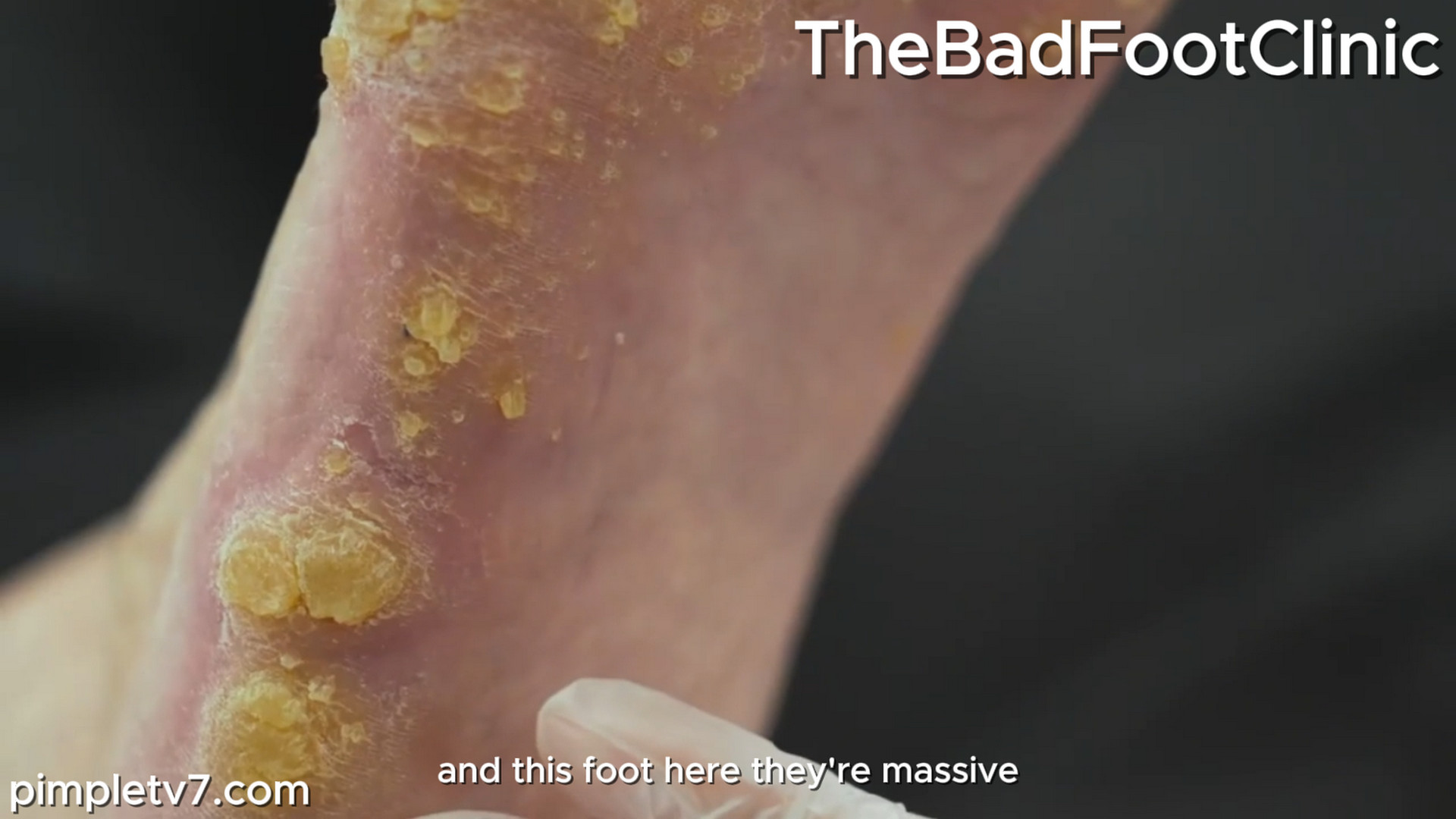 Julie, they’re awful callous lumps and bumps mainly at the sides of the foot. TheBadFootClinic 181026