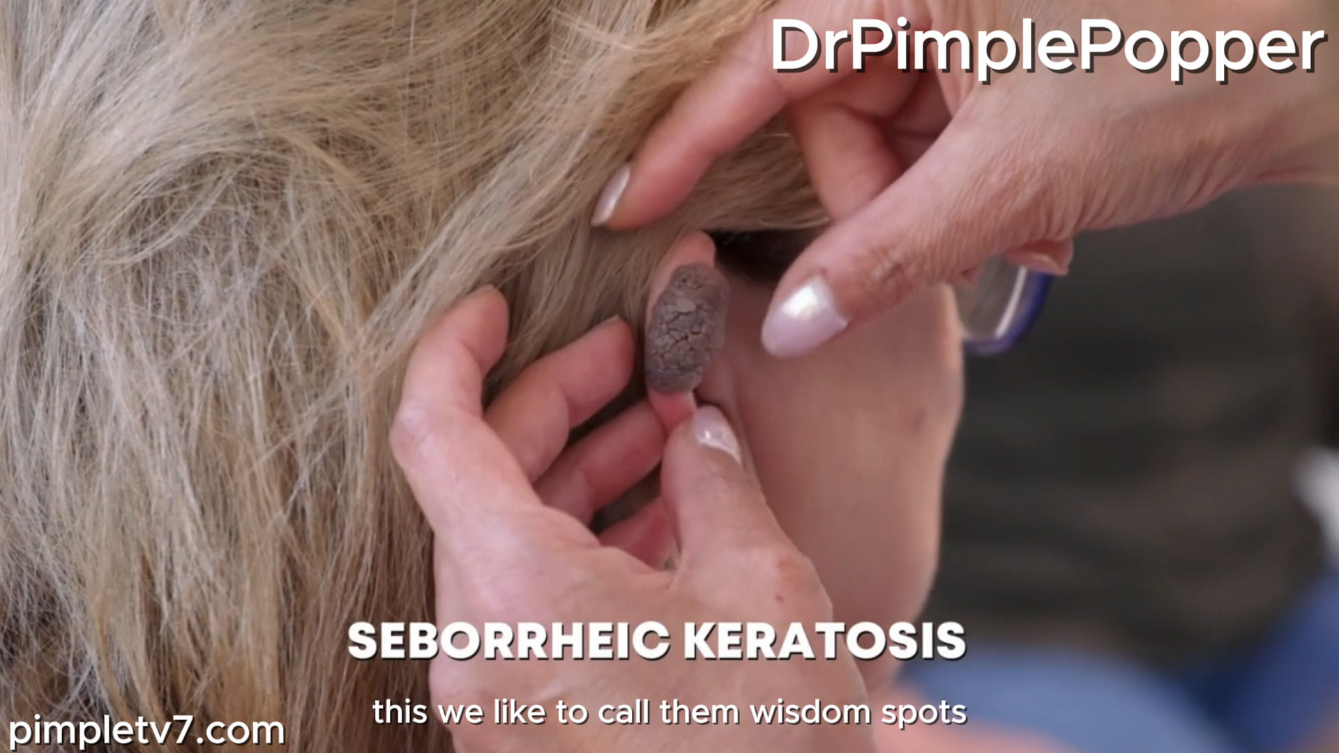 Katherine’s large ear cluster puts her neighborhood watch job at risk. Dr. Pimple Popper 281026