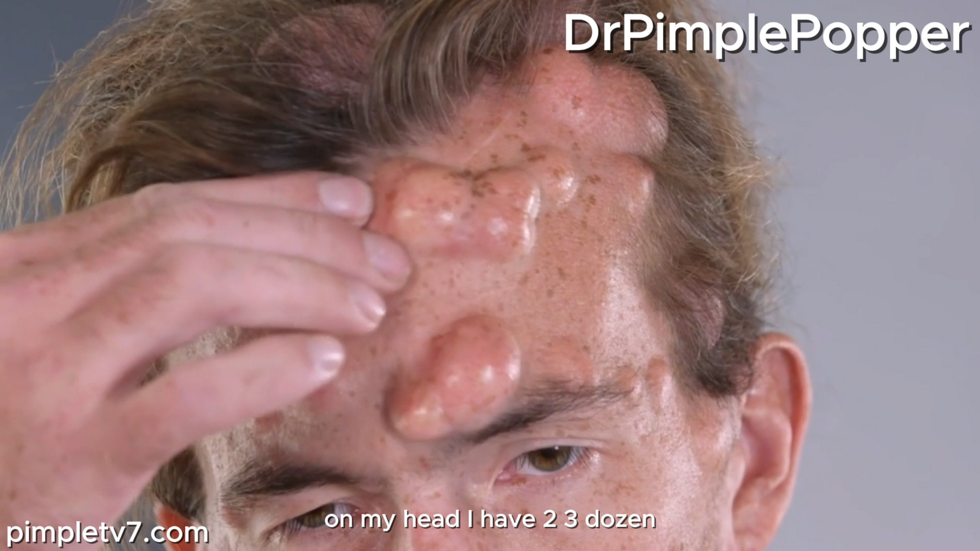 Kenny was born with a rare condition that causes hundreds of lumps to grow all over his body. Dr. Pimple Popper 181026