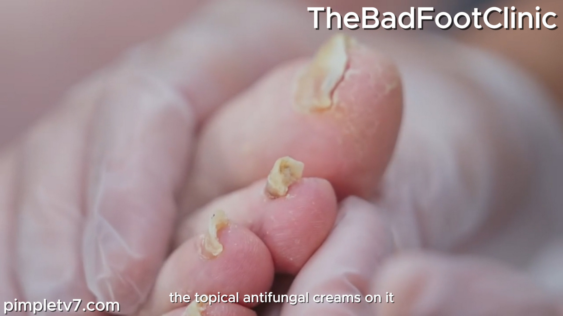 Lan’s toenails are in a terrible state. They’re curved, thick, and hard to cut. TheBadFootClinic 191026