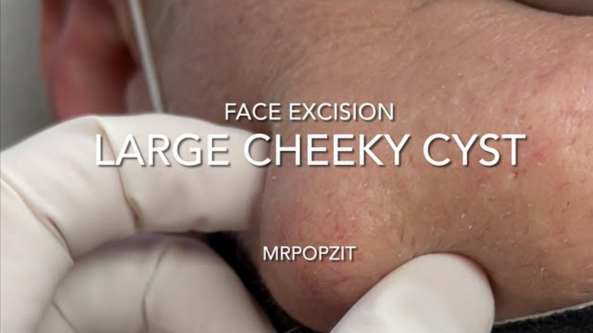 A large cheeky cyst pops over my head and splatters on me. Large face cyst excision with 1 wk follow-up. MrPopZit 131026