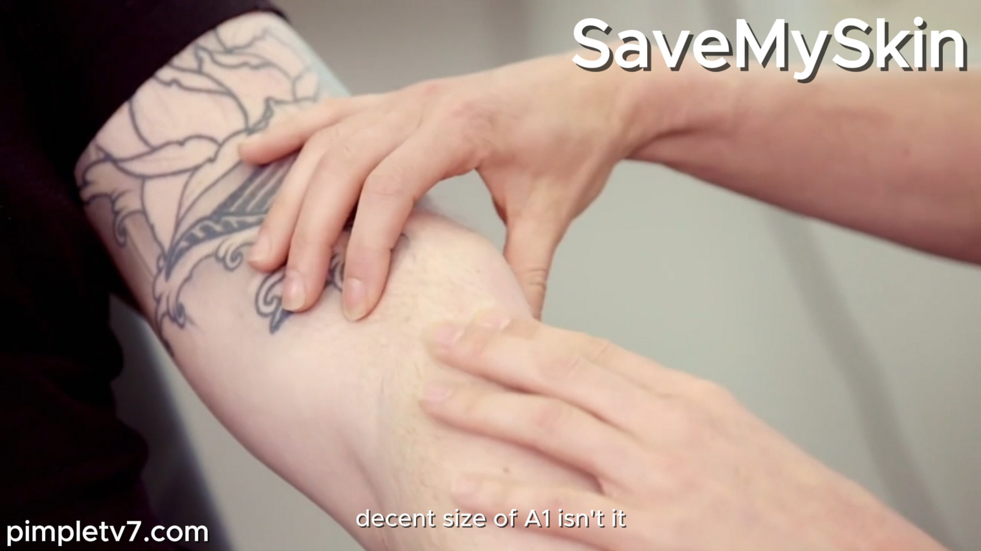 Lumps have taken over Jonathan’s body. SaveMySkin 171026
