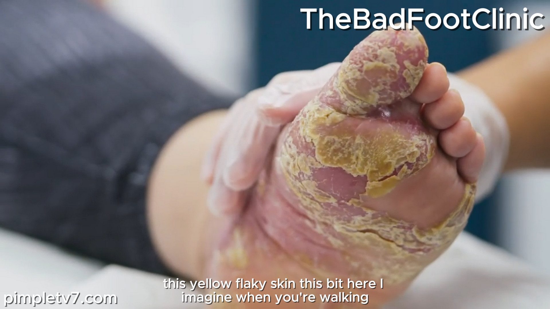 Maria, my feet look like a corpse: dry, cracked, and bleeding. TheBadFootClinic 271026