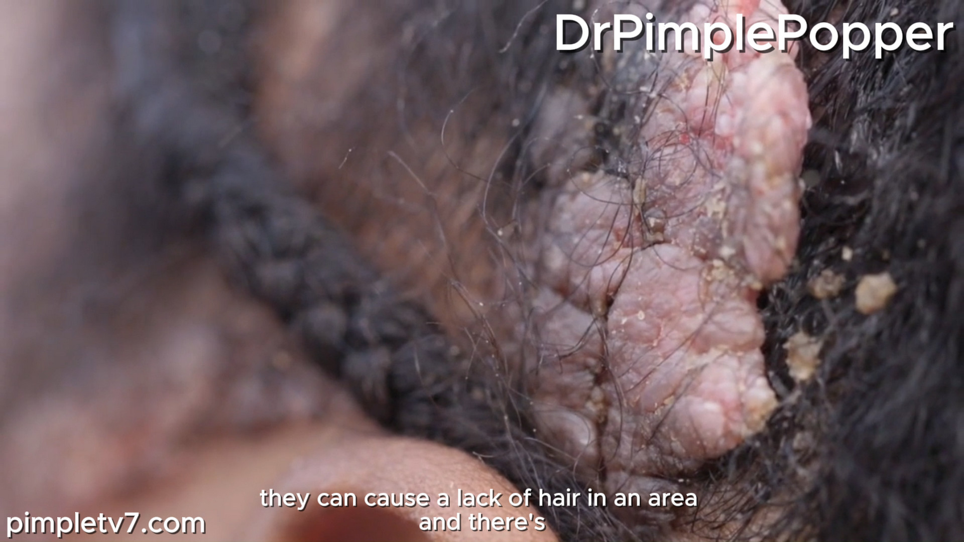 Mikalia has had a bumpy, smelly mass on her head since birth. Dr. Pimple Popper 231026