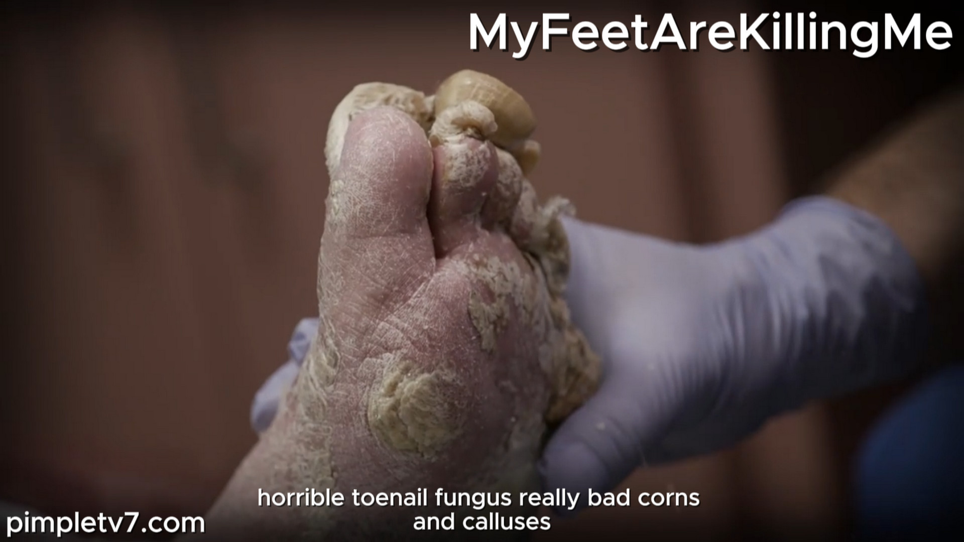 One of Dr. Brad’s most shocking patients returns for a checkup. MyFeetAreKillingMe 051026