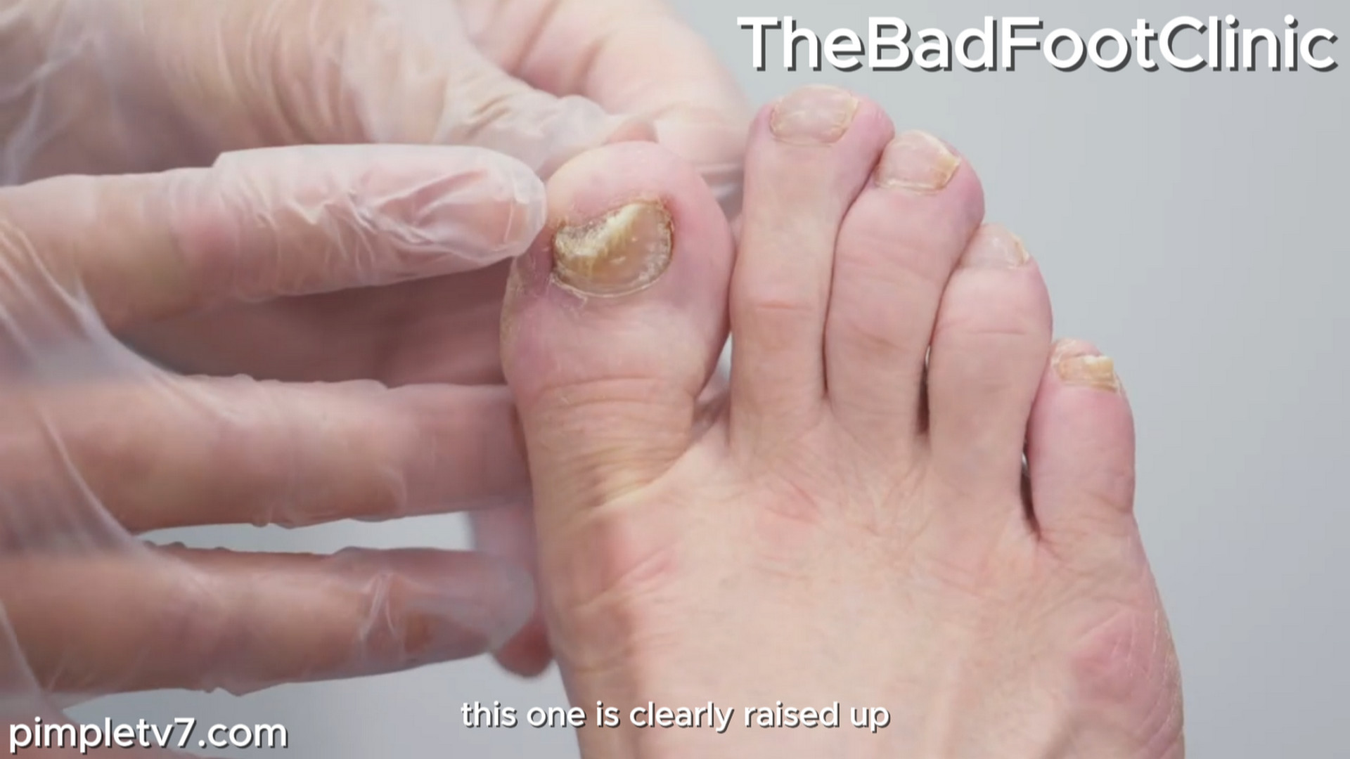 Plus, Dr. Kenny and Marion team up to help a patient with fungal feet and nails. TheBadFootClinic 151026