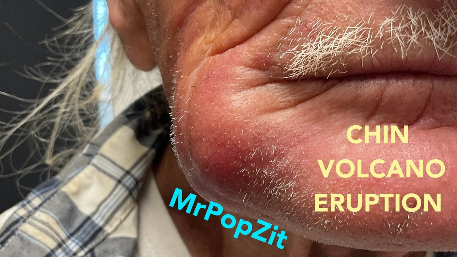 SO MUCH PRESSURE! Then POP. An inflamed cyst mounts a huge inflammatory response on the face. I+D procedure. Mr. PopZit 241026